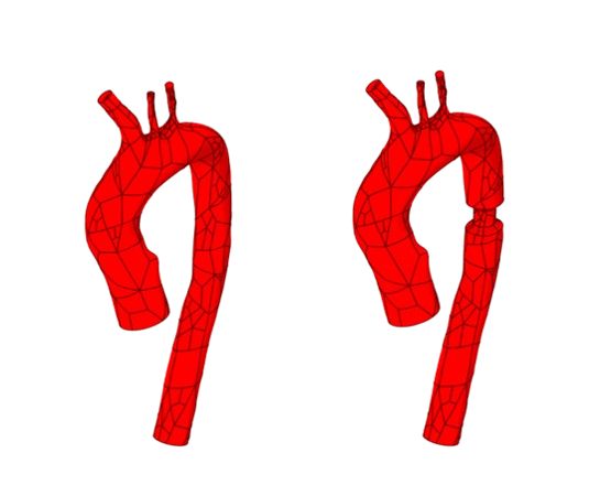 Geometry model of Aorta a) without fat deposition b) with fat deposition