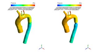 Effect Of Fat Deposition on Aorta Flow CFD Simulation, ANSYS Fluent Training
