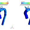 Effect Of Fat Deposition on Aorta Flow CFD Simulation, ANSYS Fluent Training