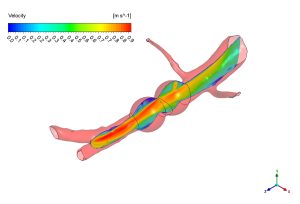 Blood Pulse Flow In Aneurysm CFD Simulation, ANSYS Fluent Training