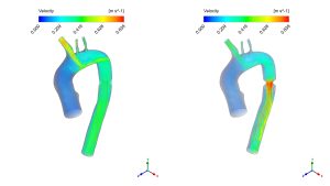 Effect Of Fat Deposition on Aorta Flow CFD Simulation, ANSYS Fluent Training