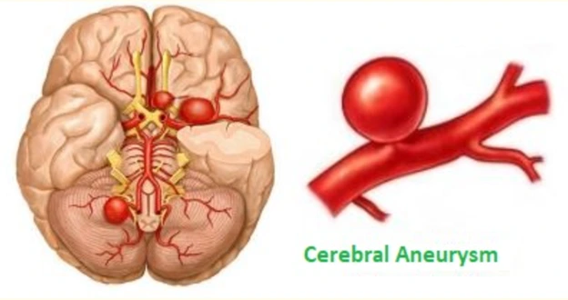 : Schematic of cerebral aneurysm