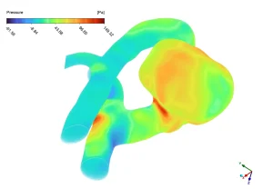 Cerebral Aneurysm CFD Analysis: ANSYS Fluent Tutorial