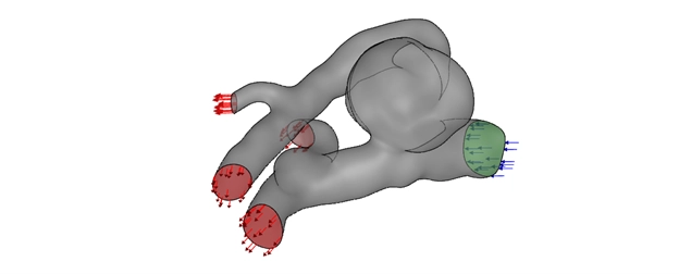 patient-specific cerebral aneurysm geometry model