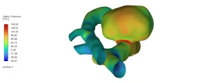 Cerebral Aneurysm CFD Analysis: ANSYS Fluent Tutorial