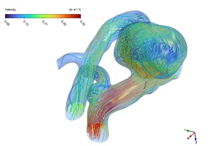Cerebral Aneurysm CFD Analysis: ANSYS Fluent Tutorial