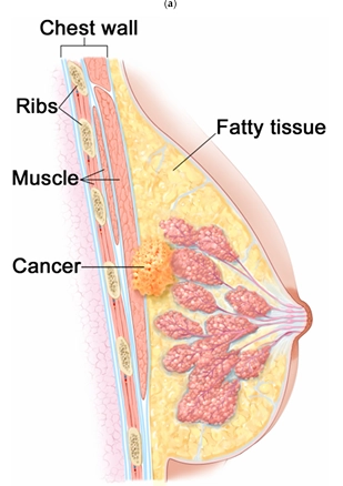 Anatomy of a breast with cancer, showing the physical biological layers of muscle, fat, and glandular tissue surrounding the hot tumor center