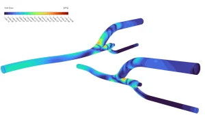 image of Pulsatile Blood Flow CFD Simulation: ANSYS Tutorial Wall shear stress contour showing friction forces along the complex bypass junction